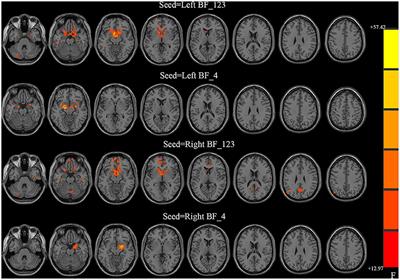 Correlation Between the Functional Connectivity of Basal Forebrain Subregions and Vigilance Dysfunction in Temporal Lobe Epilepsy With and Without Focal to Bilateral Tonic-Clonic Seizure